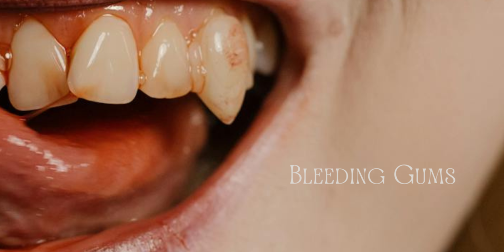 A close-up of teeth and gums showing signs of vitamin deficiency, causing bleeding gums.